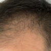 休止期毛性脱毛症の種類と症状