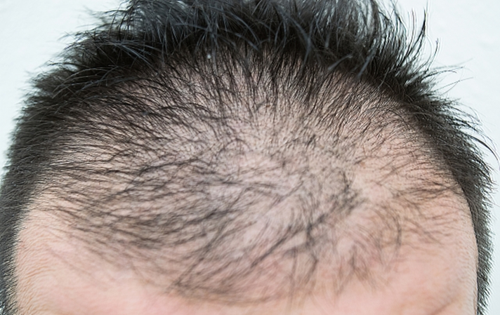 usu 090 02 男性型脱毛症の症状とヘアケアの方法