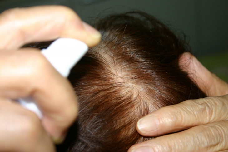 usu 090 03 男性型脱毛症の症状とヘアケアの方法