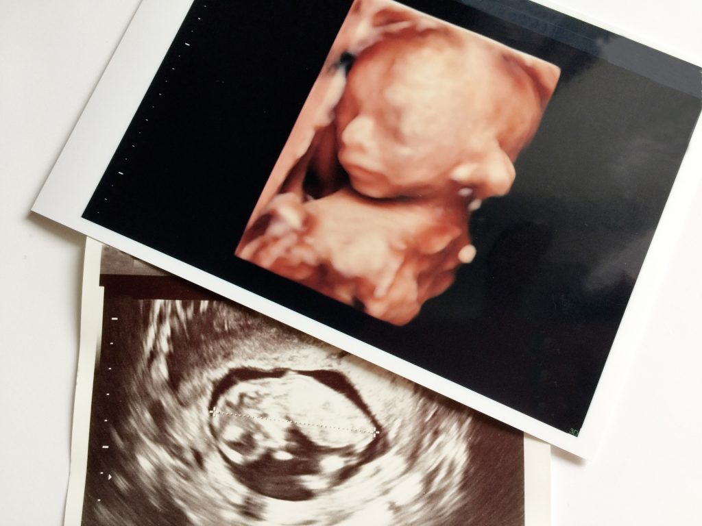 eeaf4faea39057ca18a31f2065af05eb m 1024x768 新生児にも毛が生えているのは何故？毛包の発生について